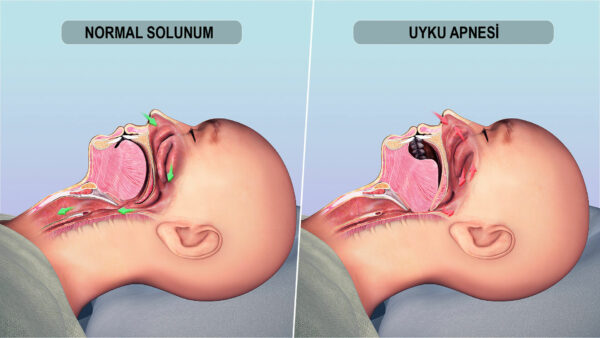 Uyku apnesine dikkat