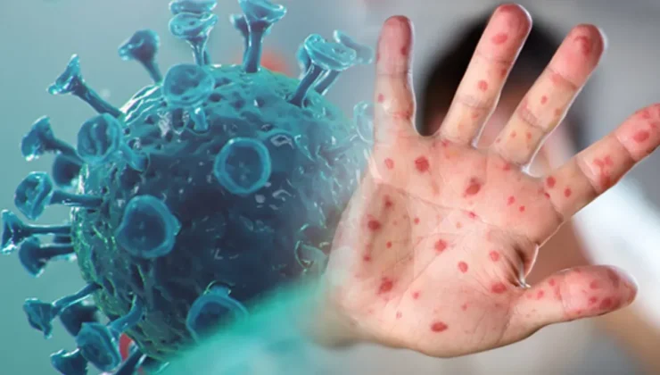 Maymun çiçeği virüsü İsveç’e sıçradı