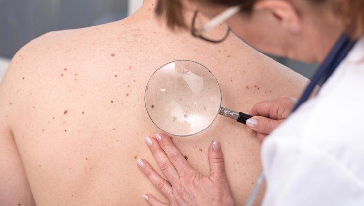 1-31 Mayıs Cilt Kanseri Farkındalık Ayı 