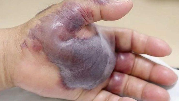 Sağlık Bakanlığı’ndan ‘vibrio bakterisi’ açıklaması